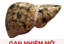 Gan nhiễm mỡ chỉ xảy ra ở người uống rượu?