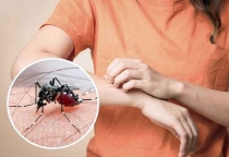 Bị sốt xuất huyết phải truyền dịch? Không phải trường hợp nào cũng cần
