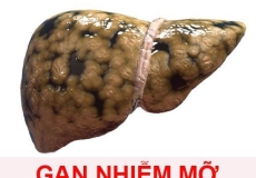 Gan nhiễm mỡ chỉ xảy ra ở người uống rượu?